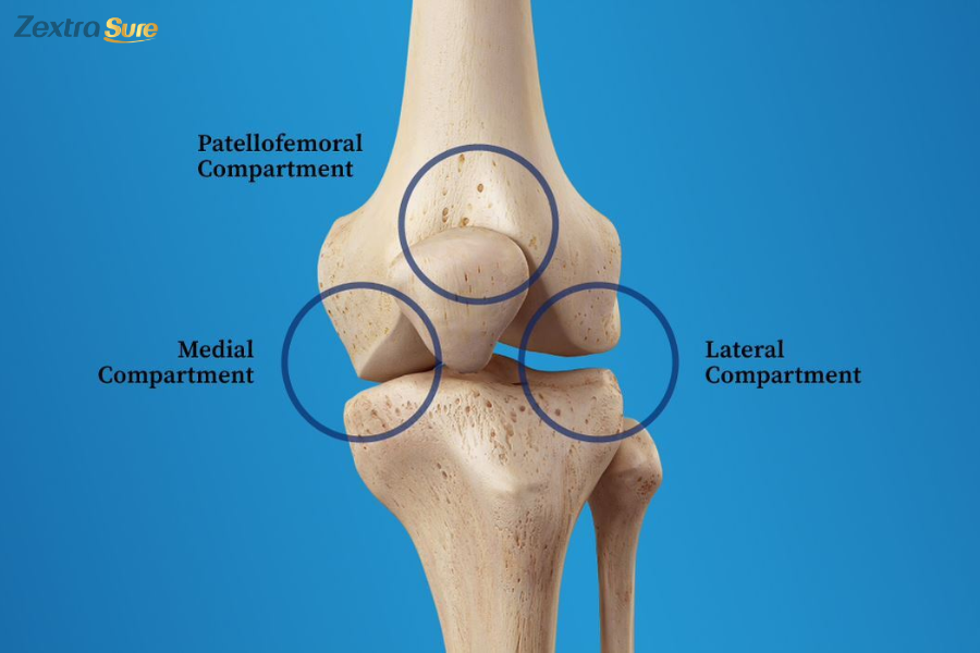 In tricompartmental osteoarthritis, all three knee compartments are affected by arthritis
